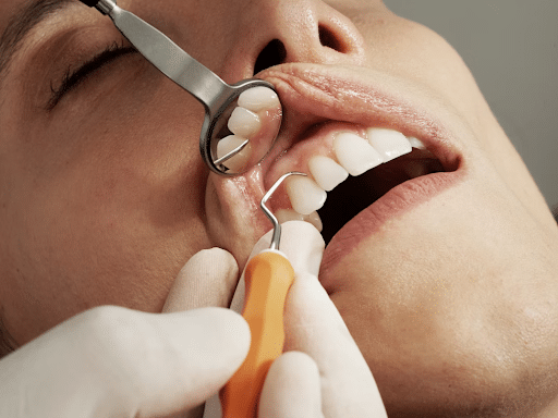 root canals