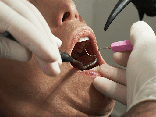 teeth cleaning