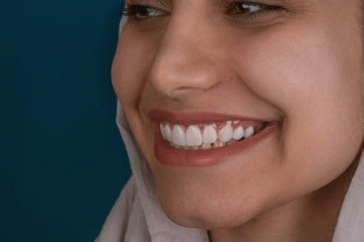 chipped tooth repair Tyler